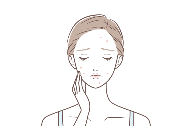 サブシジョン（ニキビ跡改善治療）